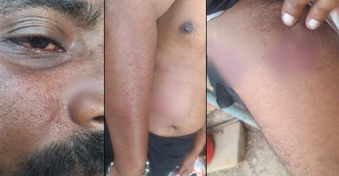 ലാത്തി കൊണ്ട് കണ്ണിലും വയറ്റിലും പുറത്തും അടി, കാഴ്ചയ്ക്കു മങ്ങൽ; ആളുമാറി യുവാവിന് കസ്റ്റഡി മർദനം