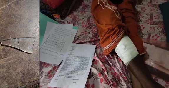 ചില്ലു നീക്കാതെ മുറിവ് തുന്നിക്കെട്ടി, വേദന സഹിച്ചത് അഞ്ചു മാസം;  മെഡിക്കല്‍ കോളജിനെതിരെ പരാതി