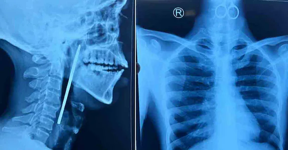 ഗവ. മാനസികാരോഗ്യ കേന്ദ്രത്തിലെ രോഗി കത്രിക വിഴുങ്ങി; അടിയന്തിര ശസ്ത്രക്രിയയിലൂടെ പുറത്തെടുത്തു