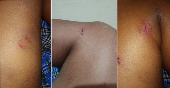 കണ്ണിൽ മുളകുവെള്ളമൊഴിച്ചു; നഖത്തിൽ ഈർക്കിൽ കയറ്റി; 12 കാരനു ക്രൂരപീഡനമേറ്റതിൽ അന്വേഷണം